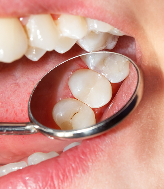 Close up of a dental mirror in a mouth reflecting a cracked tooth