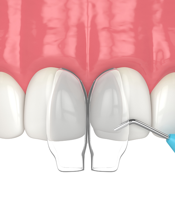 Illustration of bonding material being applied to a chipped front tooth