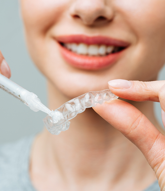 Person placing whitening gel into a tray to be worn over the teeth