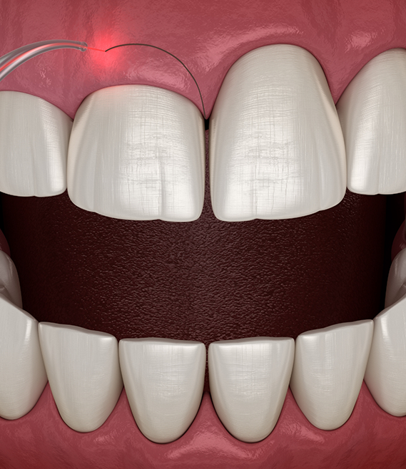 Illustration of a dental laser treating an uneven gumline