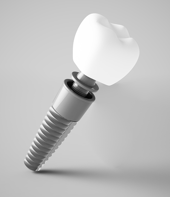 Illustration of a dental implant post abutment and crown