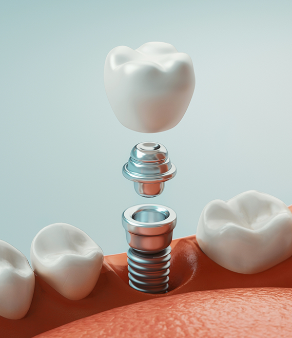 Illustration of a dental implant being placed int he lower jaw