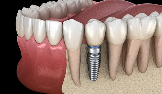 Illustration of a dental implant with a dental crown replacing a missing lower tooth