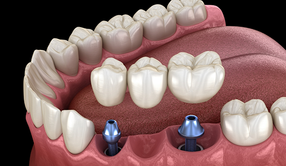 Illustration of a dental bridge being fitted over two dental implants to replace three missing teeth