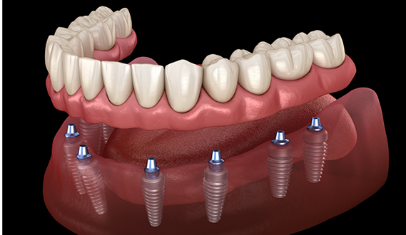 Illustration of a full denture being placed over eight dental implants throughout the lower jaw