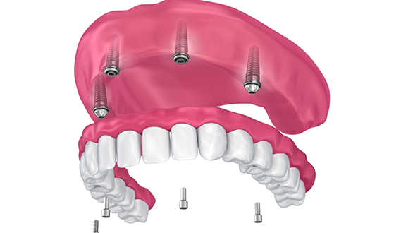 Illustration of a full denture being placed onto four dental implants throughout the upper jaw