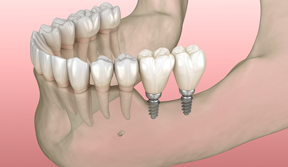 Illustration of the lower jawbone with two mini dental implants replacing the two farthest back teeth