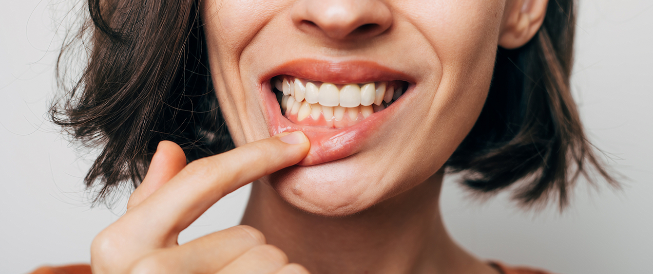 Woman pulling down her lower lip to expose healthy gums after gum disease treatment in Jacksonville