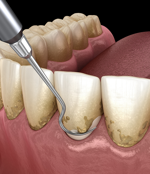 Illustrated dental scaler removing plaque buildup from along the gumline