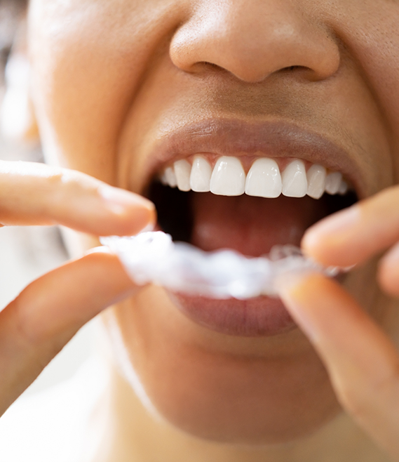 Person placing a white nightguard over their teeth