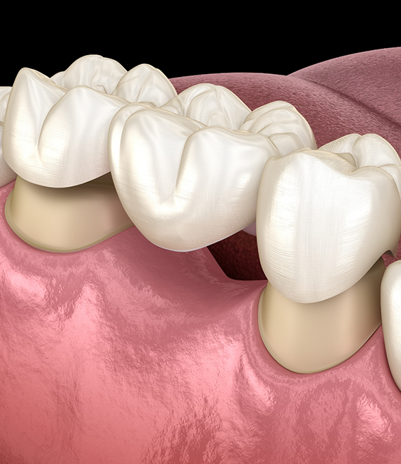 Illustration of a dental bridge being fitted over two teeth to fill the gap between them