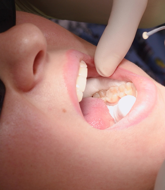 Close up of a dentist placing a tooth colored filling in a patients mouth