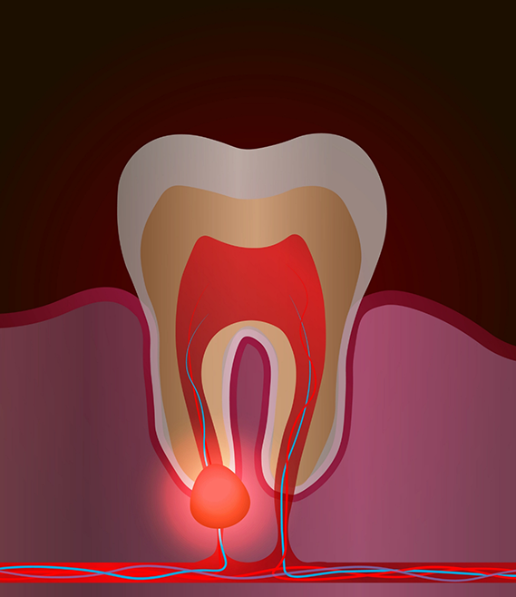 Illustration of a tooth with a bump near the root indicating an infection