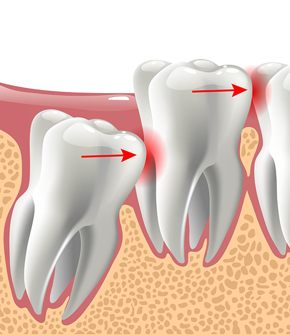 Illustration of an impacted wisdom tooth pressing against the adjacent tooth