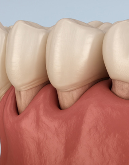 Digital view of gum pockets