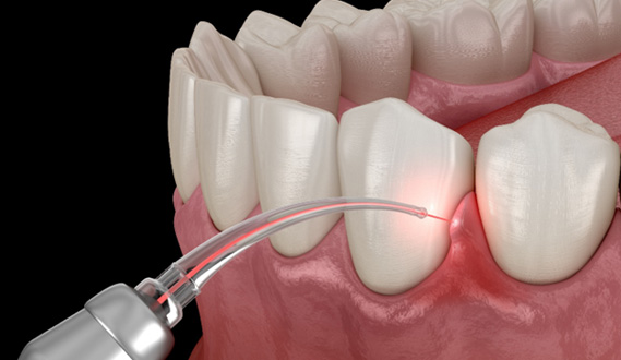 Digital view of laser periodontal treatment